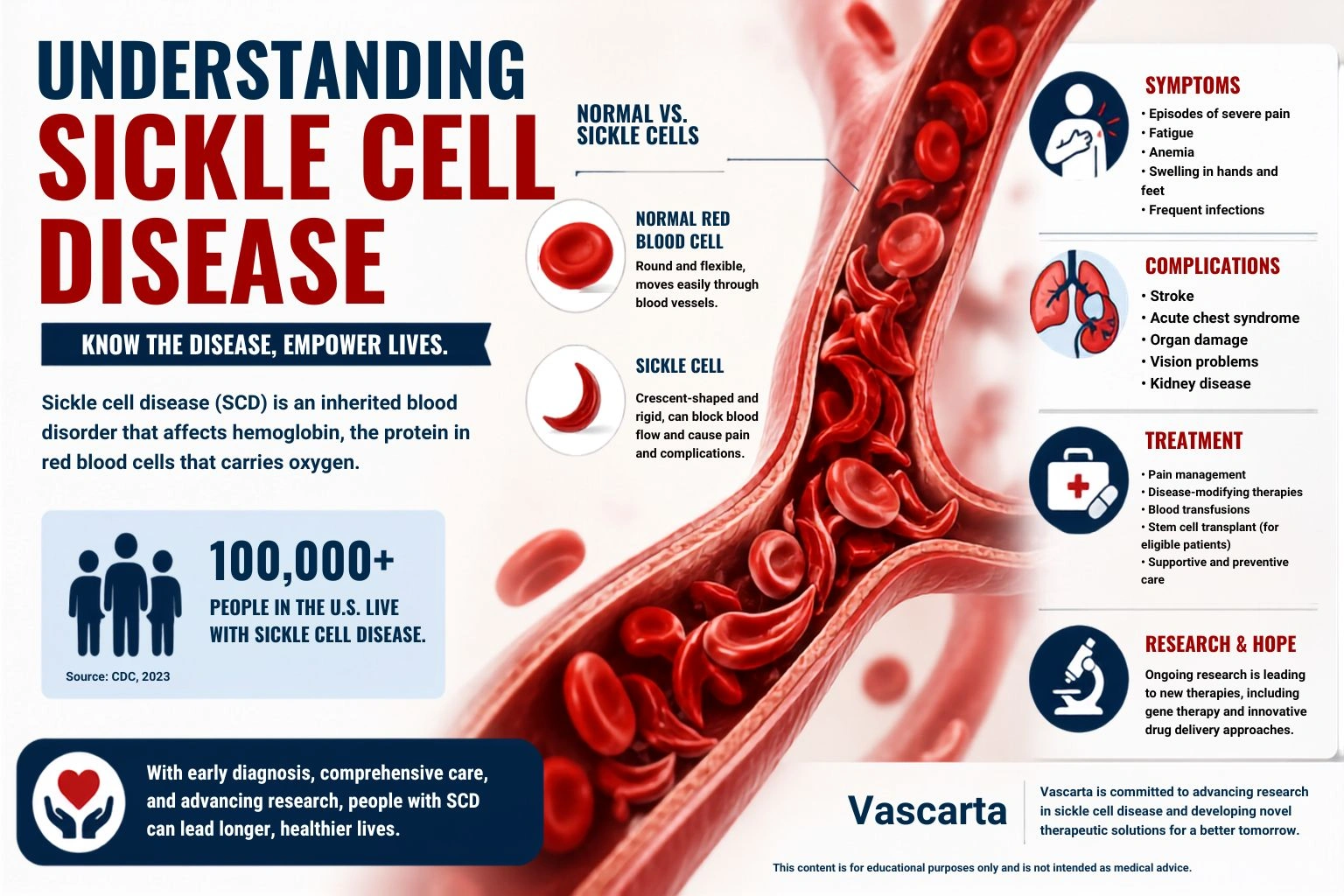Understanding Sickle Cell Disease